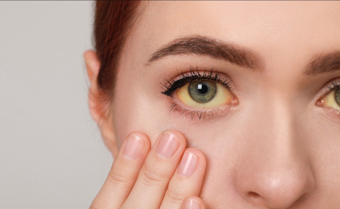 क्या है पीलिया और यह कैसे विकसित होता है ? आइये जानते हैं इसके लक्षण और कारण