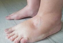 पैरों में बार-बार होने वाली सूजन को न करें नजरअंदाज, हो सकता है दिल की बीमारी का संकेत